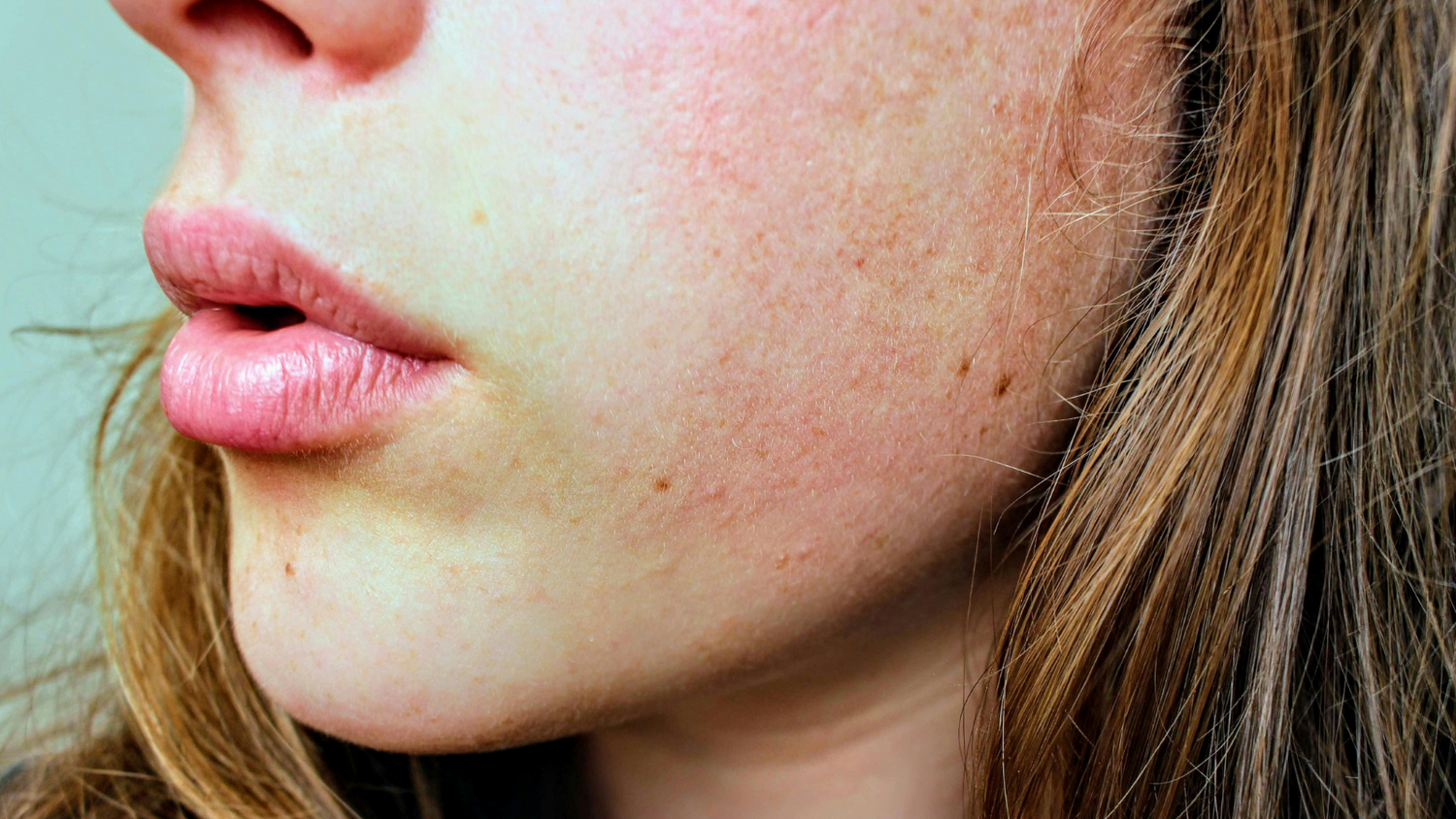 Unreine Haut durch Darmprobleme? – Wie dein Darm deinen Teint beeinflusst