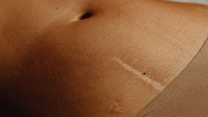 Wie kommt eigentlich ein Blähbauch zustande?